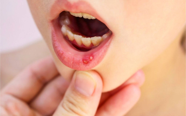 Ağızda aft nasıl geçer karbonat ve tuzlu su formülü pamukçuk için birebir - Resim: 1