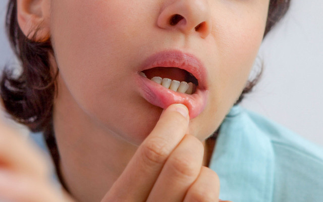 Aft nasıl kaç günde geçer afta ne iyi gelir? Ağız yarasının dermanı karbonat - Resim: 1