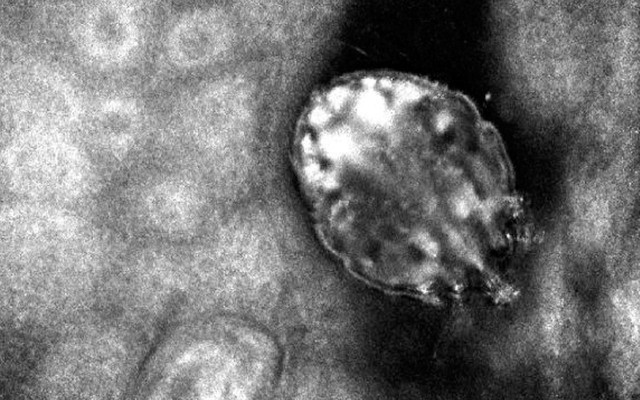 Karantinada dirençli uyuz vakaları patladı! 'Hastalar artık ailece başvuruyor' - Resim: 0