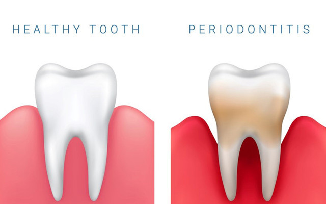 Diş eti iltihabı deyip geçmeyin! Covid-19’dan ölme riskini 9 kat artırıyor - Resim: 1