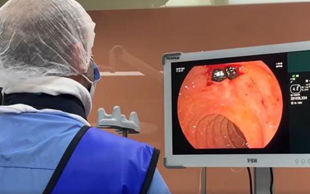 Gaz ağrısı sandı gerçek şok yaşattı! Safra kanalındaki 50 taş ağzından operasyonla çıkarıldı - Resim: 1