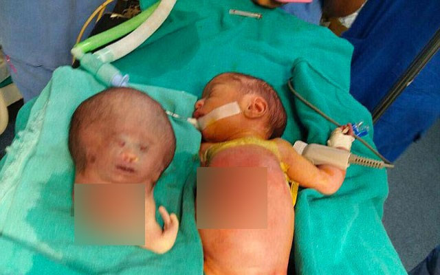 Yenidoğan bebeğin karnından çıkan doktorları şoke etti! - Resim: 3