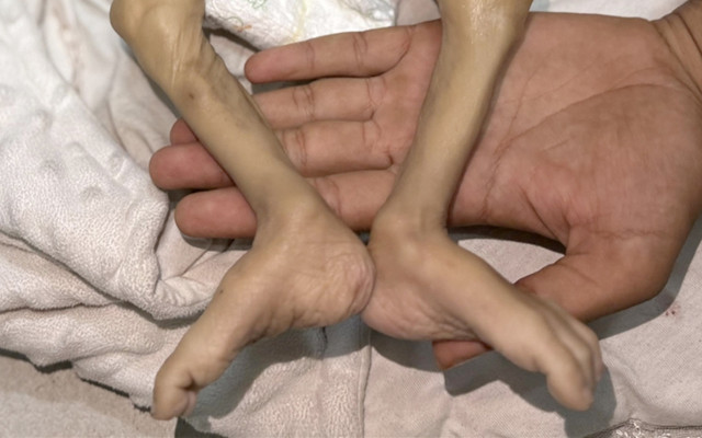 Gazze'de son 24 saatte 2'si çocuk 6 Filistinli açlıktan hayatını kaybetti