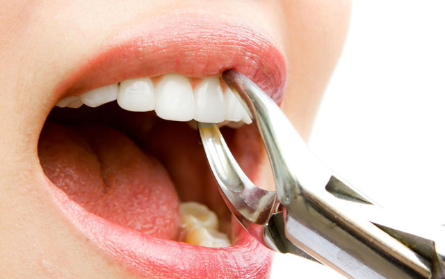 Uzmanından uyarı: 20 yaş dişlerine dikkat edilmesi gerekiyor - Resim: 0