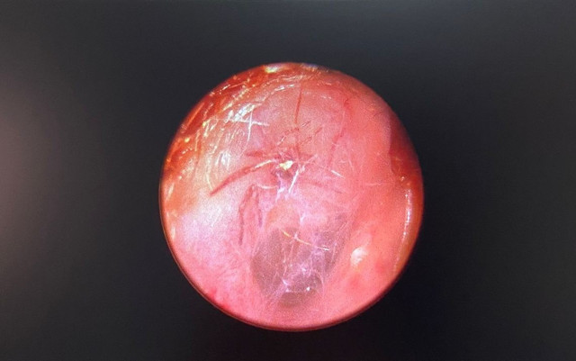 'Hışırtı' şikayetiyle doktora giden kadının kulağından canlı örümcek çıktı - Resim: 1