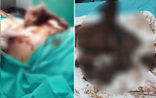 Ameliyatı yapan doktor şoke oldu! Midesinden çıkana bakın - Resim: 1