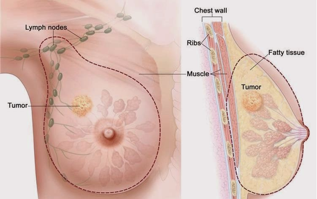 Uzmanı: Düzenli mamografi takibi ile meme kanseri daha erken evrede saptanabilir - Resim: 2