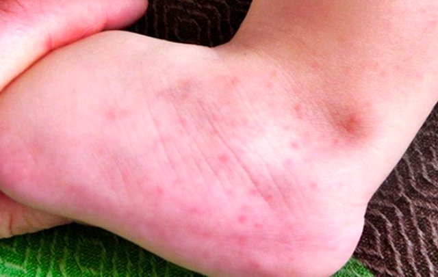 Ayakta kırmızı lekeler neden olur hastalık belirtisi mi? - Resim: 0