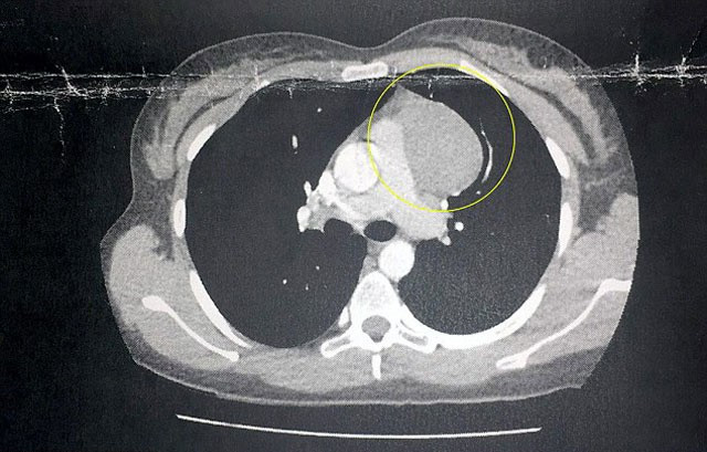 Epilasyondan tahriş oldu sandı kanser çıktı! - Resim: 4