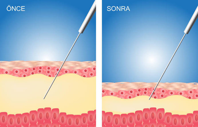 Liposakşın neden çok popüler? Hangi teknikler ve hangi bölgelere uygulanıyor - Resim: 3