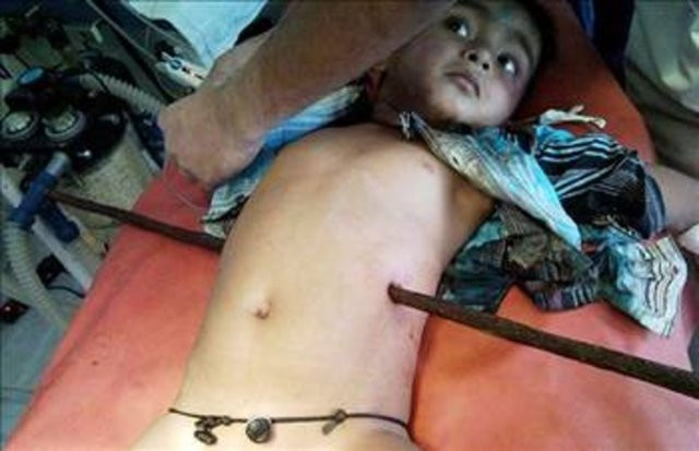 Tıp tarihine geçmiş en korkunç vakalar - Resim: 3