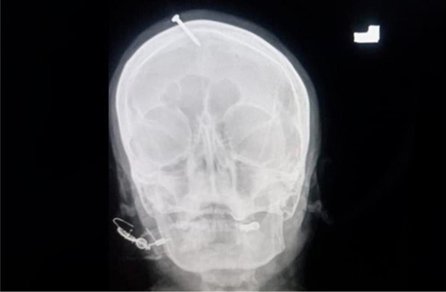 Pakistan’da korkunç olay! Erkek çocuk doğurması için hamile kadının kafasına 5 santimetrelik çivi çaktılar - Resim: 0