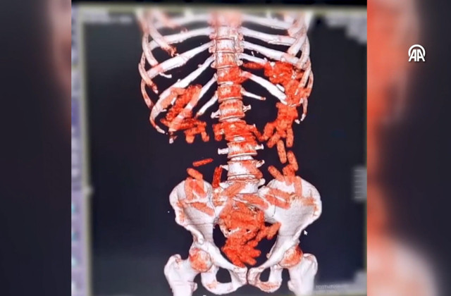 Kayseri'de bir zanlının mide ve bağırsağında uyuşturucu madde bulundu - Resim: 0