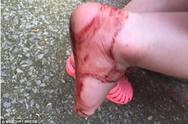 Sadece yarım saat giydi ayağı bu hale geldi! - Resim: 1