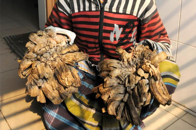 Ağaç adam Abul Bajander bakın nasıl iyileşiyor! - Resim: 1