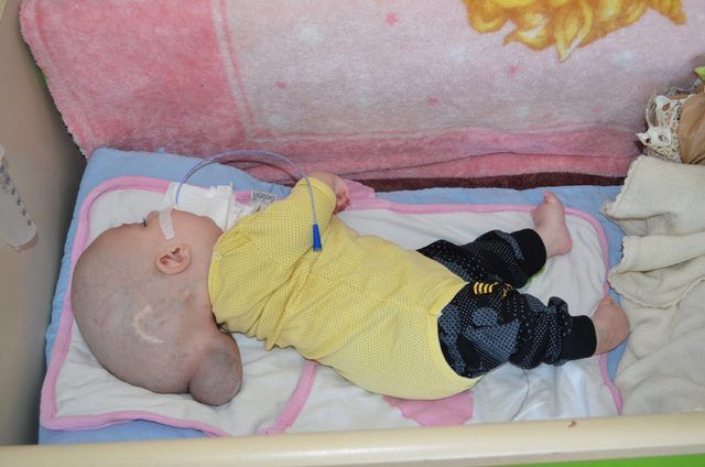 12 aylık bebeği görenler şoke oluyor! Beyni kafatasının dışında büyüyor - Resim: 1