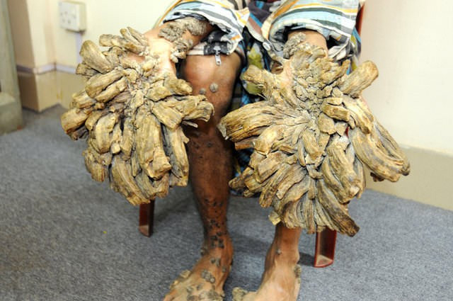 Ağaç adam Abul Bajander bakın nasıl iyileşiyor! - Resim: 2