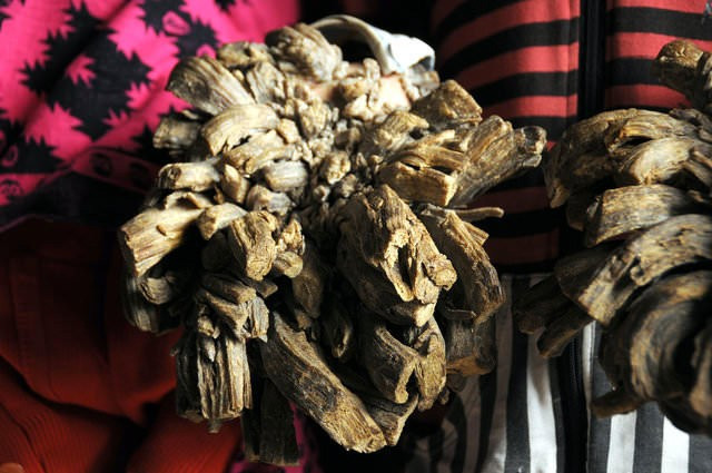 Ağaç adam Abul Bajander bakın nasıl iyileşiyor! - Resim: 3