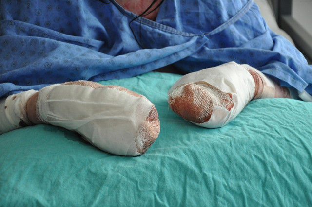 Parmakları bitişikti, ABD'li genç kız şifayı Eskişehir'de buldu! 2 ay içinde... - Resim: 0