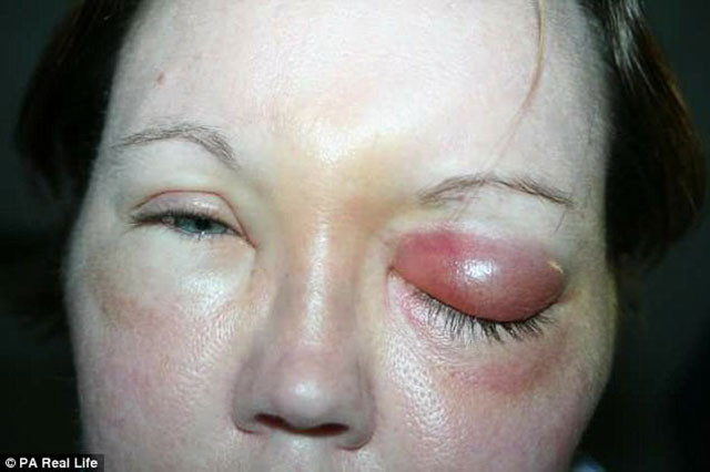 Lensinden bulaşan mikrop hayatını kararttı - Resim: 4