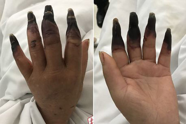 Parmakları biranda karardı sebebini duyunca şoke olacaksınız - Resim: 1