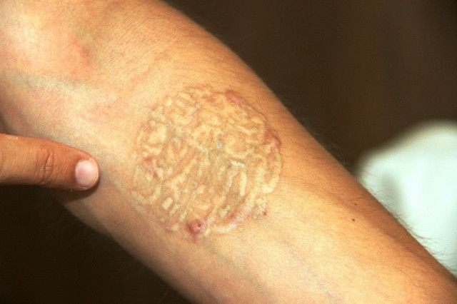 Bodrum'da asker olmak için dövmelerini sildiren genç hayatının şokunu yaşadı - Resim: 1