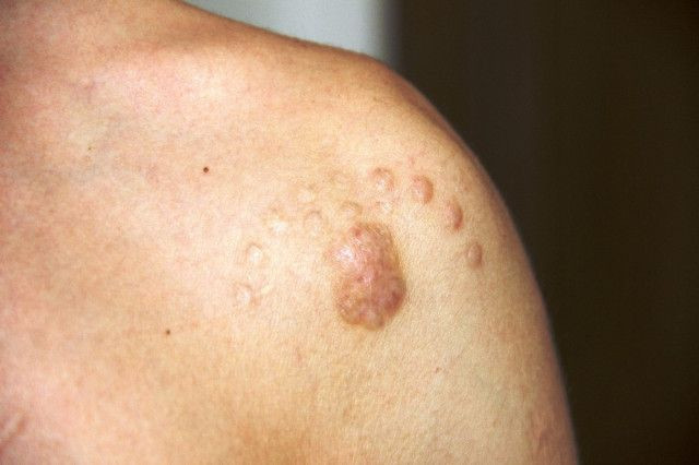 Bodrum'da asker olmak için dövmelerini sildiren genç hayatının şokunu yaşadı - Resim: 2