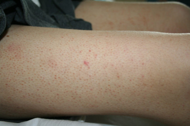 Ayakta kırmızı lekeler neden olur hastalık belirtisi mi? - Resim: 1