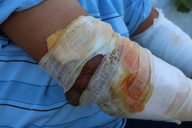 Denizli'de alevlerin arasında kalan vatandaş: Kollarımın eridiğini gördüm - Resim: 0