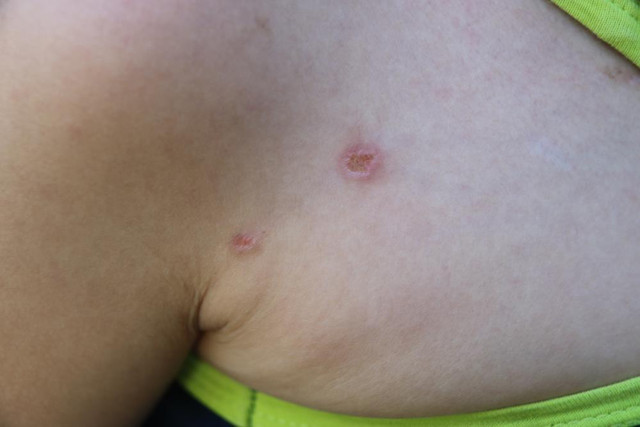 Küçük çocuğun üzerinde sigara söndürüldü iddiası! Eski karı-koca birbirini suçladı - Resim: 0