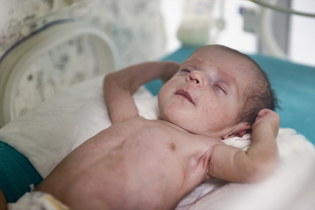 Kıbrıslı Nehir bebek "25 binde 1" görülen hastalığından Türkiye'de kurtuldu - Resim: 1