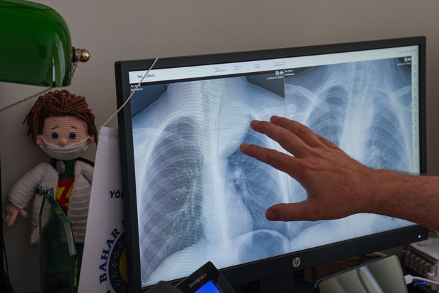 Nefes darlığı çeken çocuğun göğüs boşluğundan yaklaşık yarım kilogramlık kitle çıkarıldı - Resim: 1