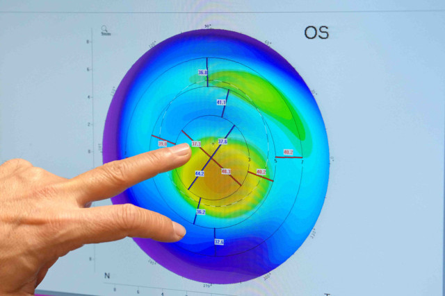 Hafife almayın! Görme bozukluğunun altında bu hastalık olabilir - Resim: 1