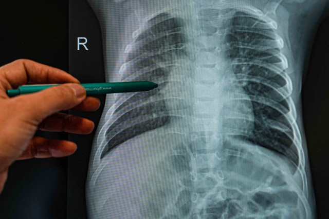 Alerjik çocuklarda enfeksiyon riski daha yüksek! - Resim: 0