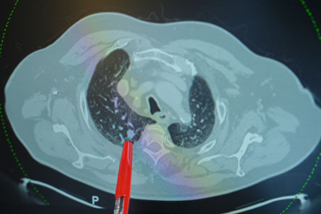 Akciğer sönmesi gençleri tehdit ediyor! - Resim: 1