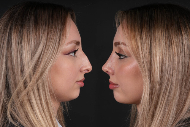 Burun estetiğinde nelere dikkat edilmeli? - Resim: 1