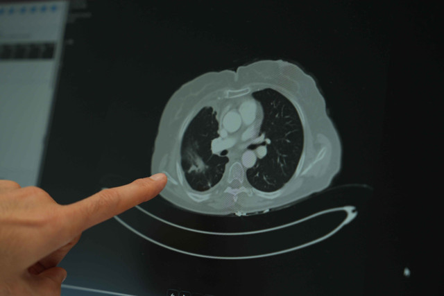 Gençlerde kanser vakaları artıyor! Doç. Dr. Melih Şimşek değerlendirdi - Resim: 0