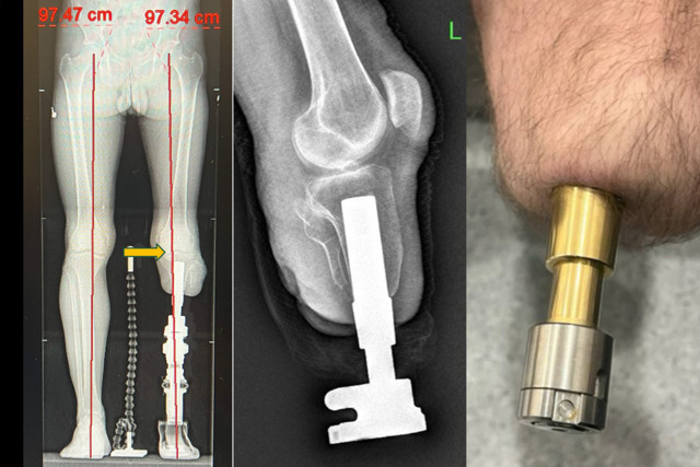 Bu yöntem amputasyon hastalarına umut oldu - Resim: 1