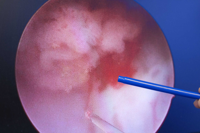 İdrarındaki kanı önemseyince hayatı kurtuldu! - Resim: 1