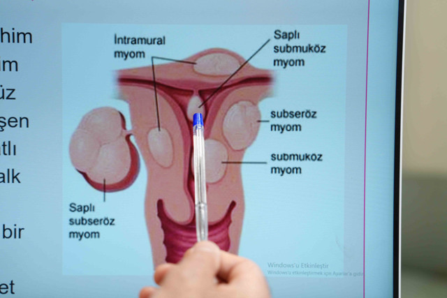 3 kadından birinde miyom var! Prof. Mesut Polat kanama belirtisine dikkat çekti - Resim: 0