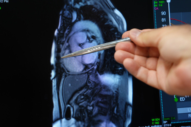 Kalbi taşlaştı, yıllarca yanlış tedavi gördü! Çareyi Medipol'de buldu - Resim: 1