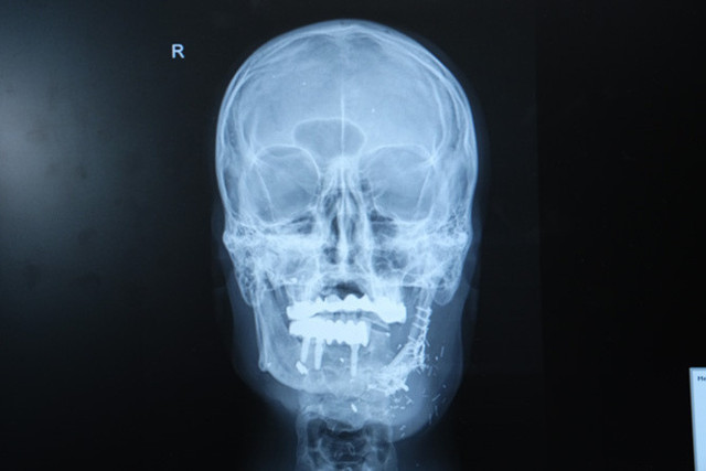 Çenesi parçalandı, umudunu kaybetmedi! Medipol'den başarılı operasyon - Resim: 0