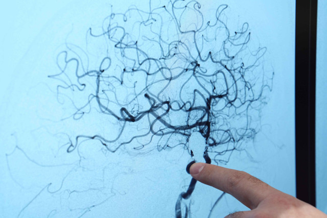 Beyin anevrizması her 20 kişiden birinde görülebilir - Resim: 1