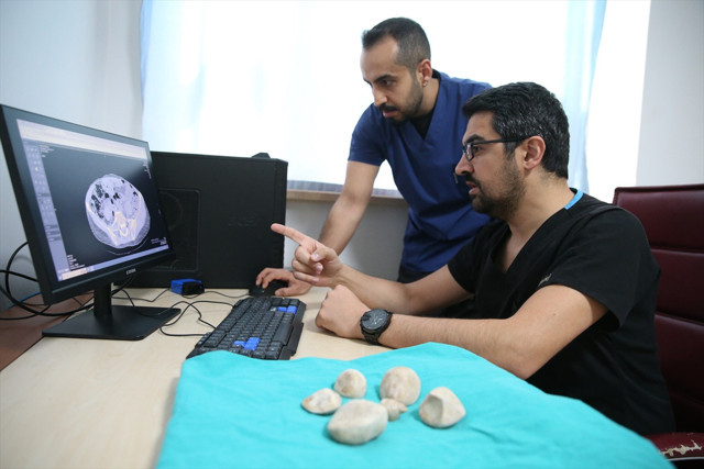 Doktorları bile şaşırttı! 43 yaşındaki kadının idrar kanalı ve mesanesinden 6 taş çıktı - Resim: 1