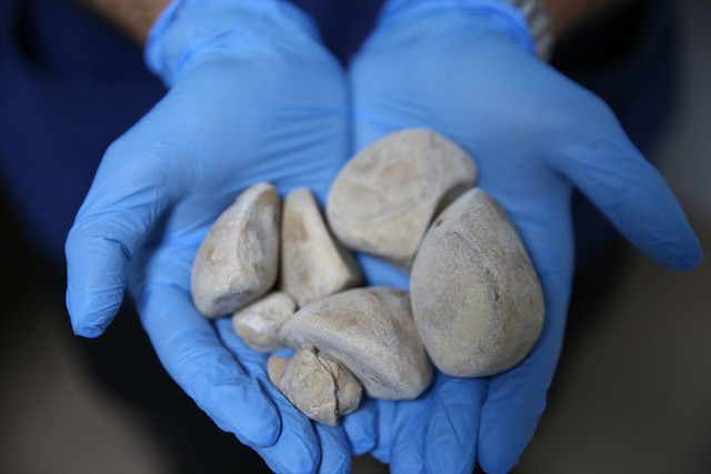 Doktorları bile şaşırttı! 43 yaşındaki kadının idrar kanalı ve mesanesinden 6 taş çıktı - Resim: 2