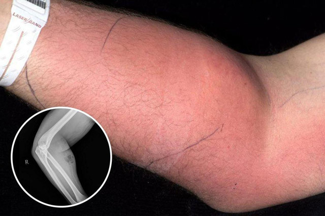 18 ay boyunca koluna sperm enjekte etti! Bakın sonrasında ne oldu - Resim: 1