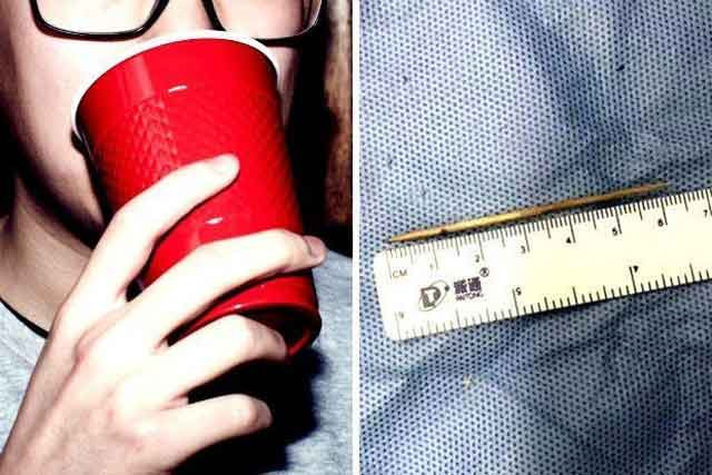 Yuttuğu kürdan kalbinden çıktı tıp dünyası şoka girdi!  - Resim: 1