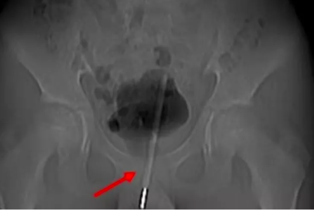 12 yaşındaki çocuğun cinsel organından çıktı! Annesi gerçeği itiraf etti - Resim: 0