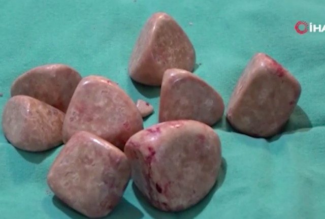 Karın ağrısı için hastaneye gitti karnından çıkanlar dumur etti! Gören kalakaldı - Resim: 0