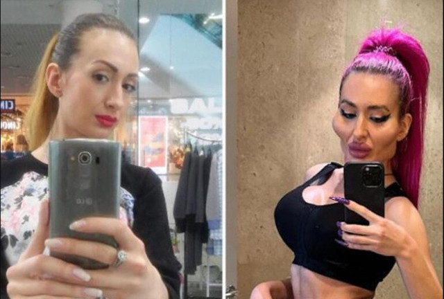 Doktorlar uyardı o vazgeçmiyor! Dünya'da tek olmak istiyor: Ameliyat için yeniden Türkiye'ye geldi! - Resim: 1